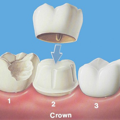 Протезирование зубов, металлокерамика, безметалловая коронка